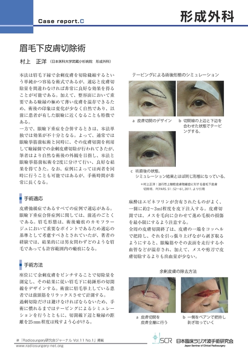 【形成外科】Case report C　眉毛下皮膚切除術