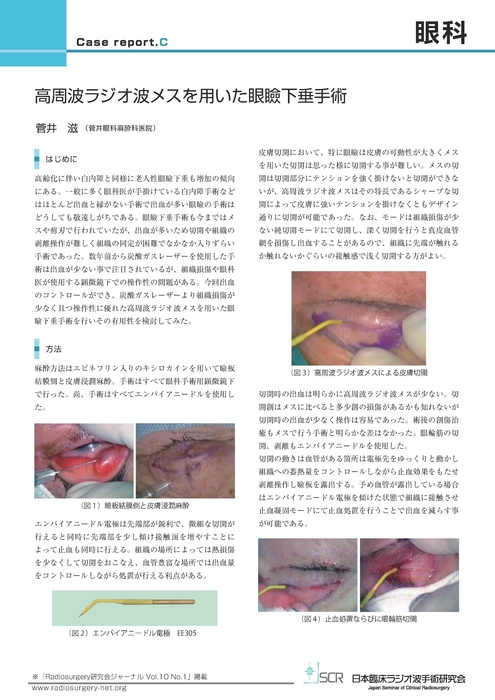 【眼科】Case report C　高周波ラジオ波メスを用いた眼瞼下垂手術