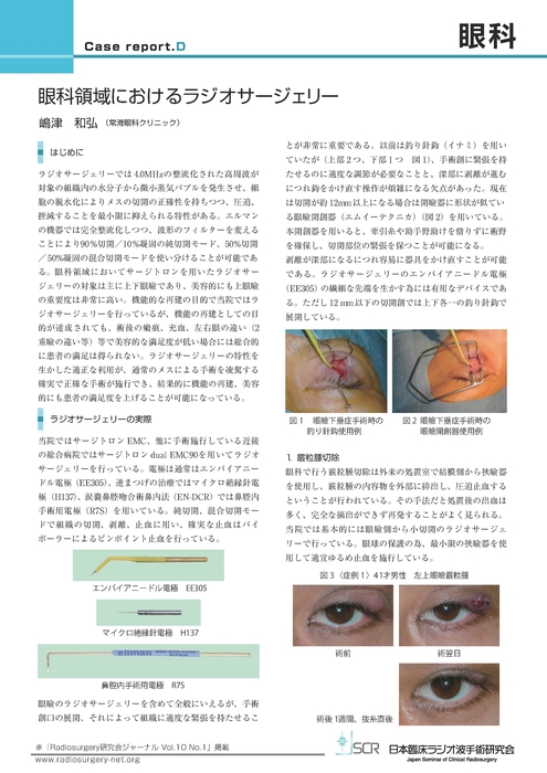 【眼科】Case report D　眼科領域におけるラジオサージェリー