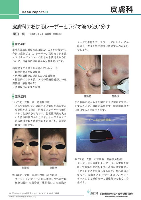 【皮膚科】Case report D　皮膚科におけるレーザーとラジオ波の使い分け