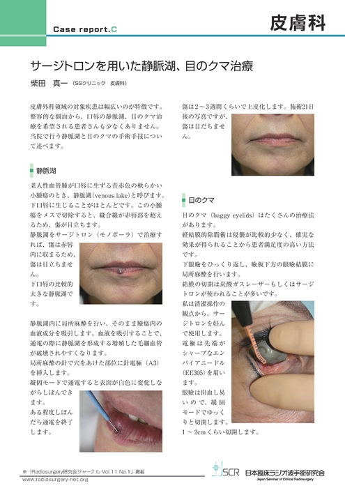 【皮膚科】Case report C　サージトロンを用いた静脈湖、目のクマ治療