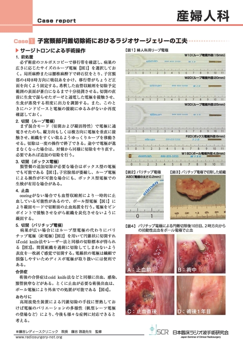 【産婦人科】Case report A　子宮頚部円錐切除術におけるラジオサージェリーの工夫