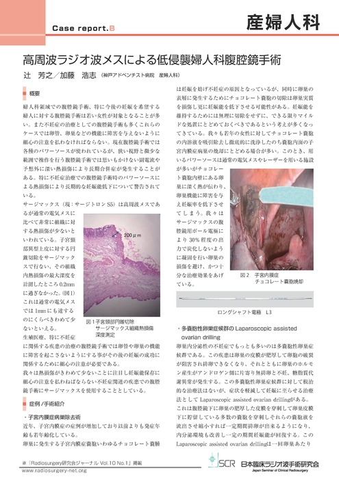 【産婦人科】Case report B　高周波ラジオ波メスによる低侵襲婦人科腹腔鏡手術