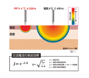 侵襲範囲の小さな電気メス