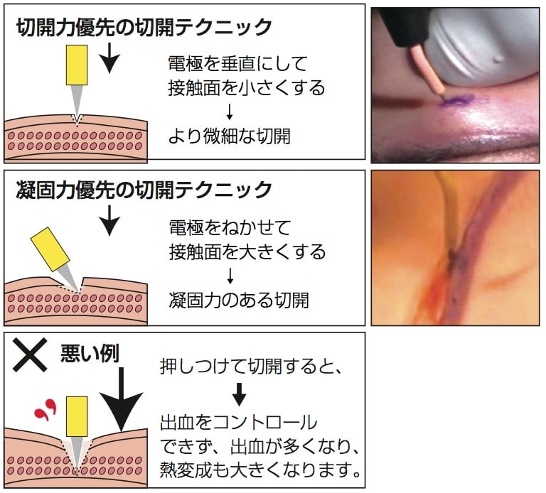 獣医科での貸出について 切開・凝固のコツ