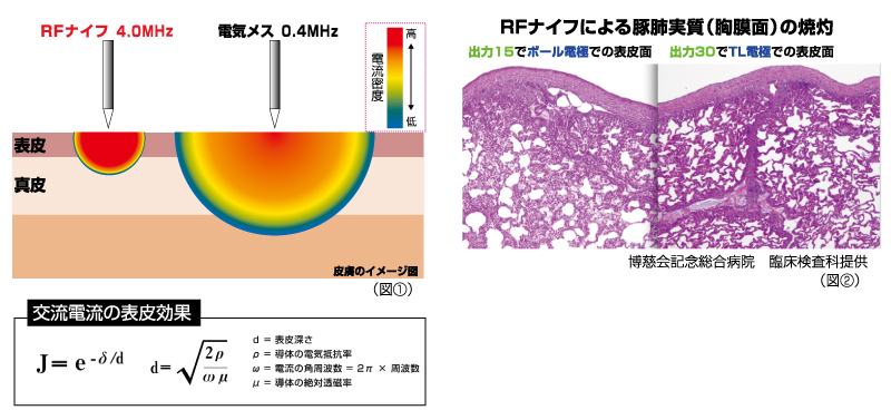 RFナイフの特徴②　侵襲範囲の小さな電気メス