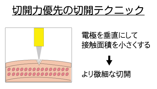 RFナイフ（サージトロン） 切開のコツ