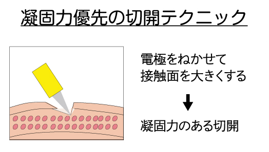 RFナイフ（サージトロン） 止血のコツ