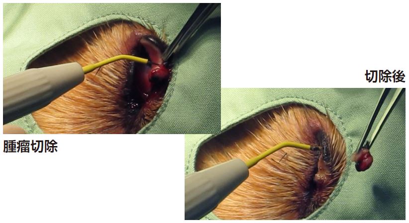 眼瞼腫瘤摘出（マイボーム腺腫）