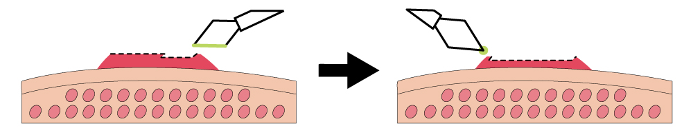 ダイヤモンド型ループ電極の切除操作3