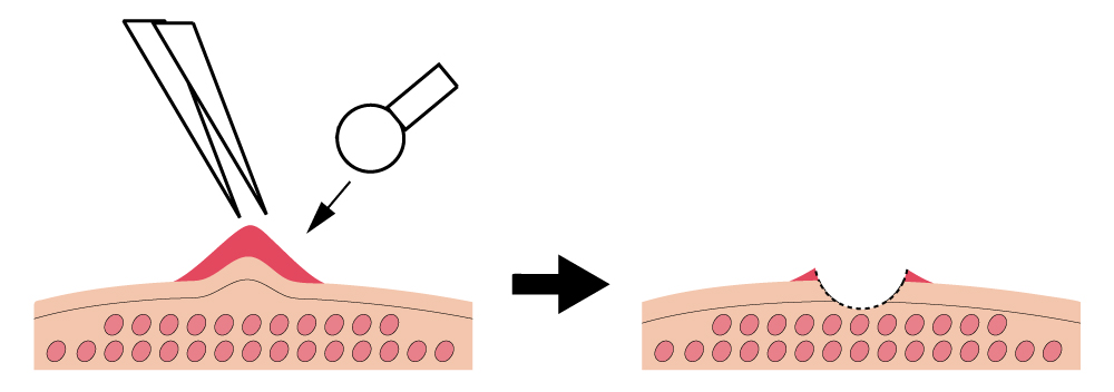 切除操作の注意点1