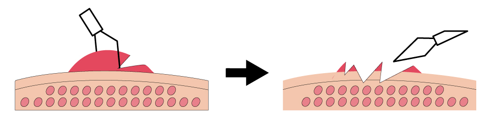 切除操作の注意点2