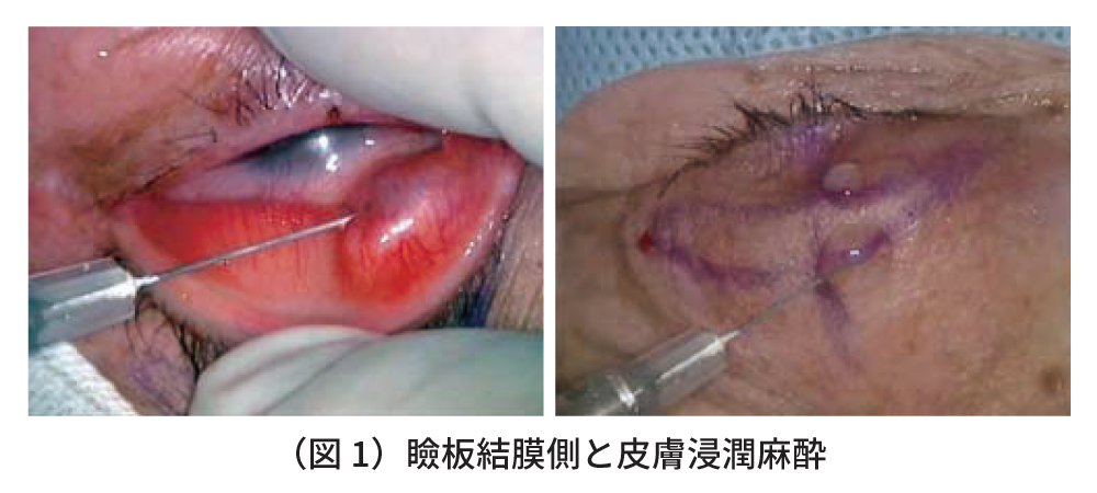 高周波ラジオ波メスを用いた眼瞼下垂手術　図1