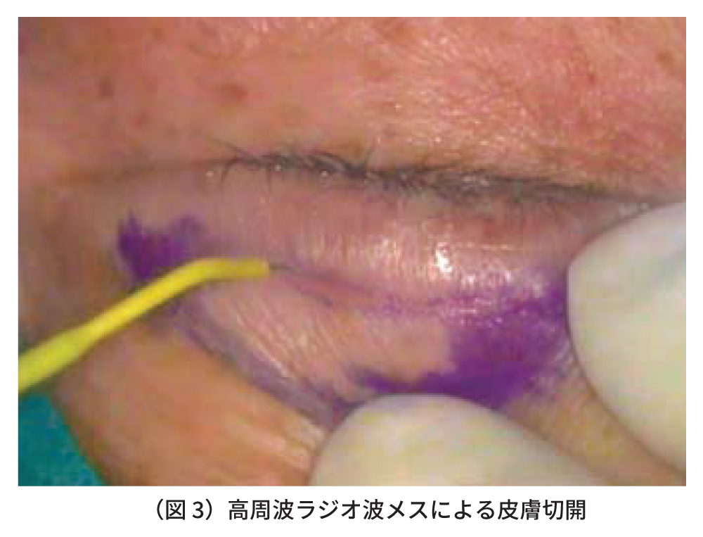 高周波ラジオ波メスを用いた眼瞼下垂手術　図3