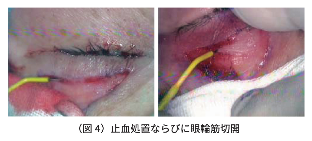 高周波ラジオ波メスを用いた眼瞼下垂手術　図4