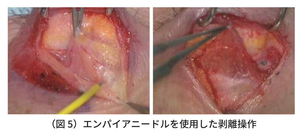 高周波ラジオ波メスを用いた眼瞼下垂手術　図5