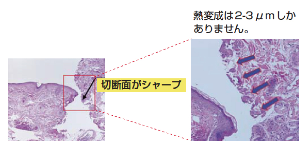 皮膚切開