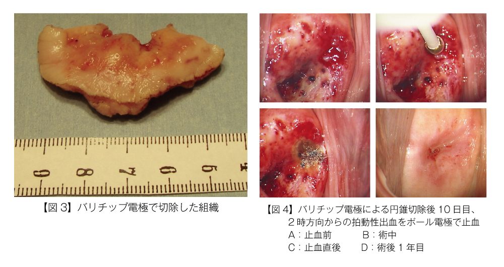 【図3】バリチップ電極で切除した組織、【図4】バリチップ電極による円錐切除後10日目、2時方向からの拍動性出血をボール電極で止血
