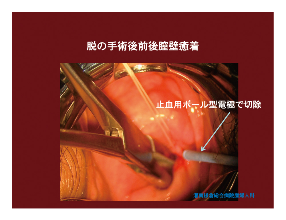 脱の手術後前後膣壁癒着