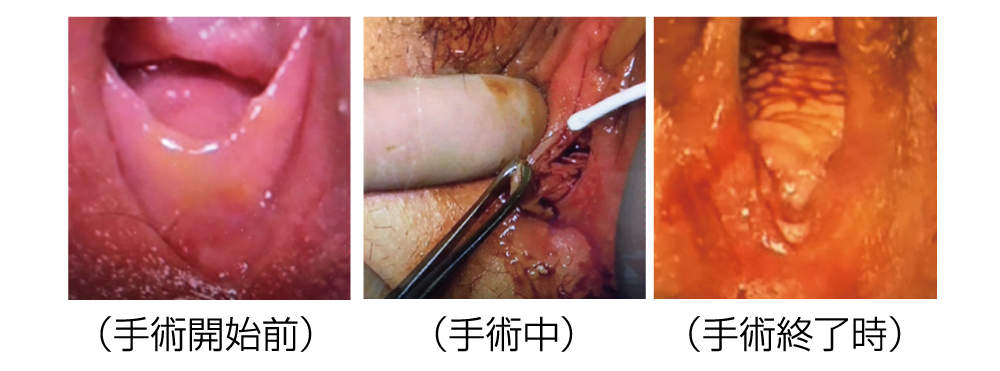 サージトロン針状電極（A2D・A8D）を用いた若年女性の外陰部手術図2