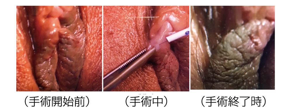 サージトロン針状電極（A2D・A8D）を用いた若年女性の外陰部手術図3